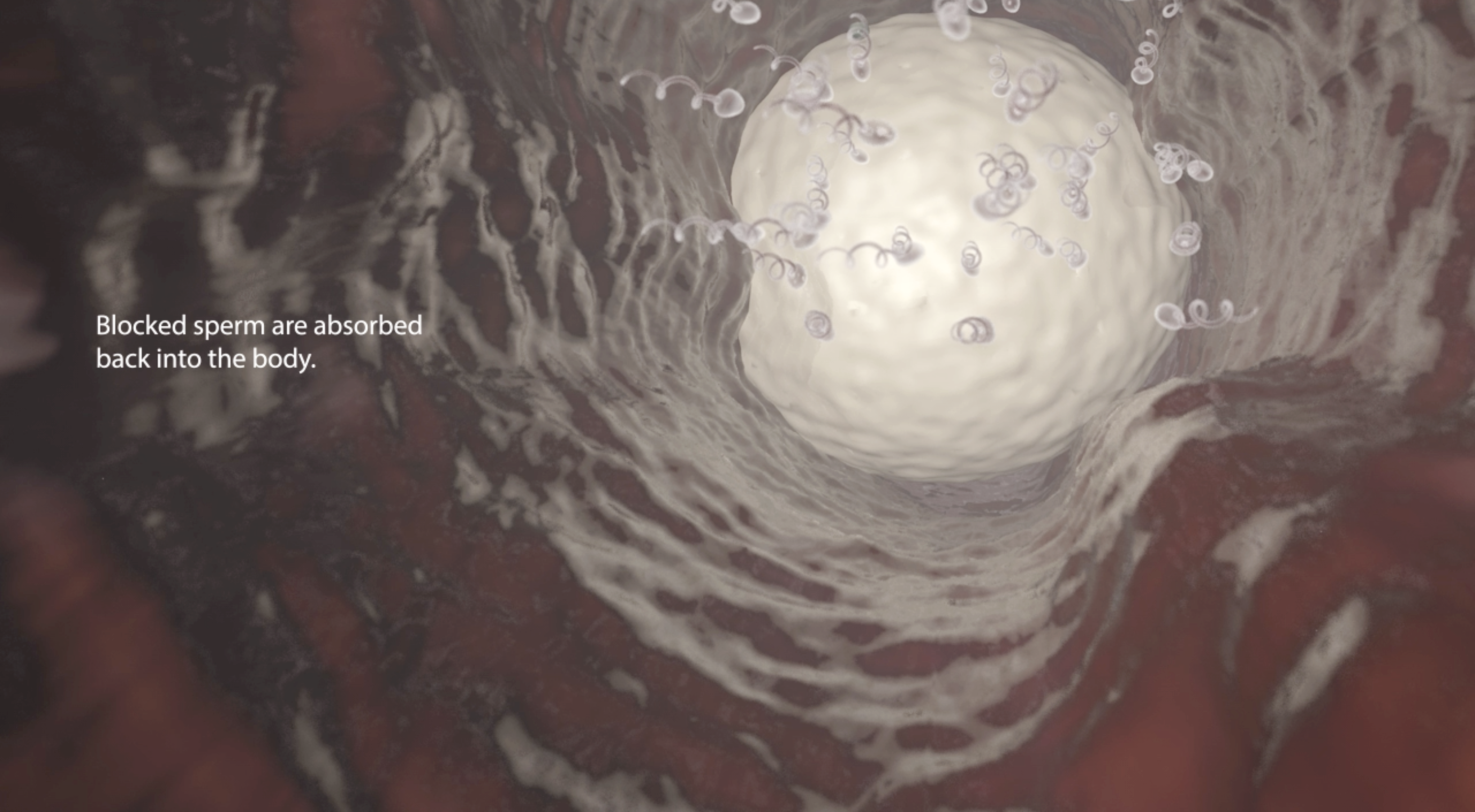 3D representation of Vasalgel blocking sperm in a human vas deferens
