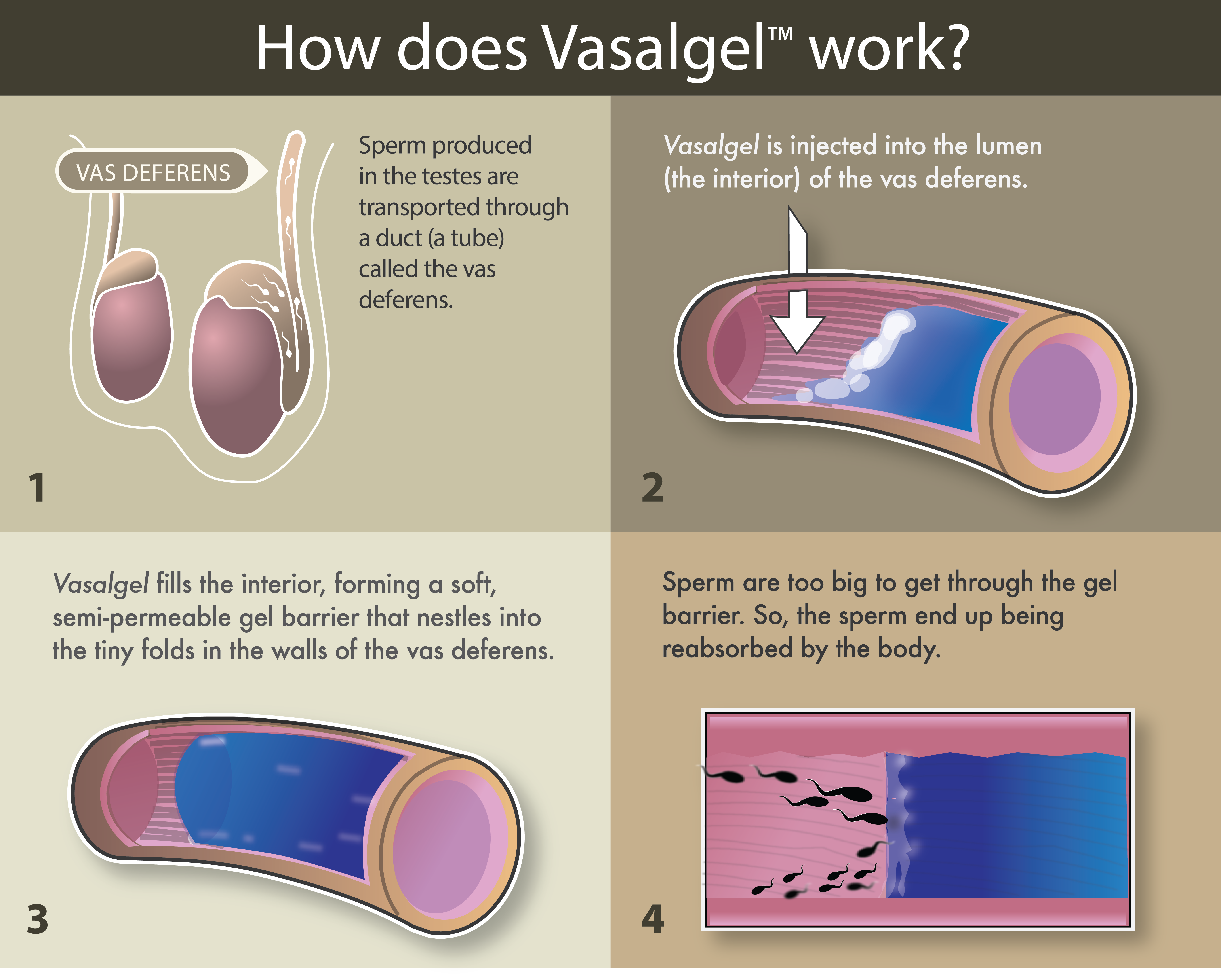 Infographic shows how Vasalgel works.